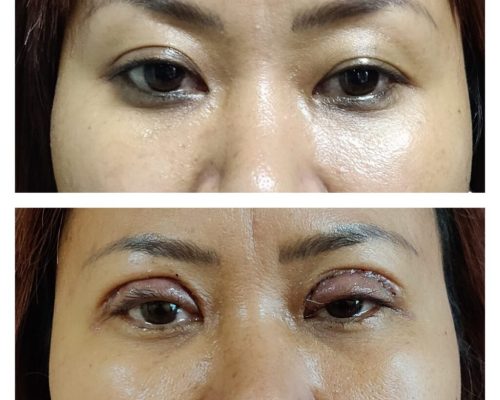Blepharoplasty-1-1024x1024