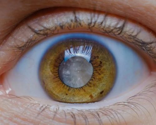 Cataract surgery_ 5 do’s and don’ts