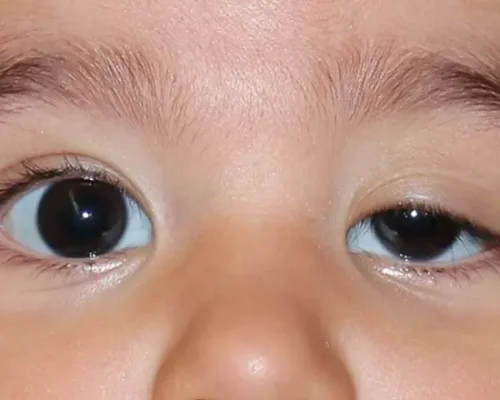 Congenital-Eye-Disorders-drhc-dubai