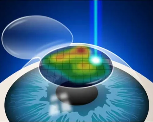 Custom-Wavefront-LASIK-A-Revolutionary-Approach-to-Vision-Correction.jpg