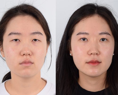 Eyelid-Surgery-Patient-48-1