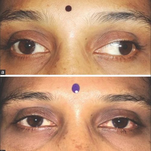 Strabismus surgery guide