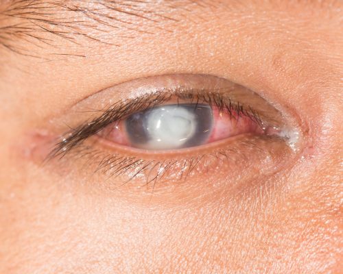 eyeconcepts_corneal-ulcer