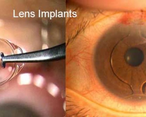 iol-intraocular-lens-implant