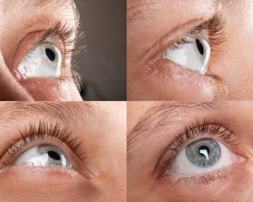 woman eye with corneal dystrophy, keratoconus, thinning of the cornea.