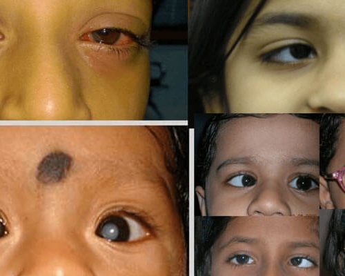 paediatric-ophthalmologist