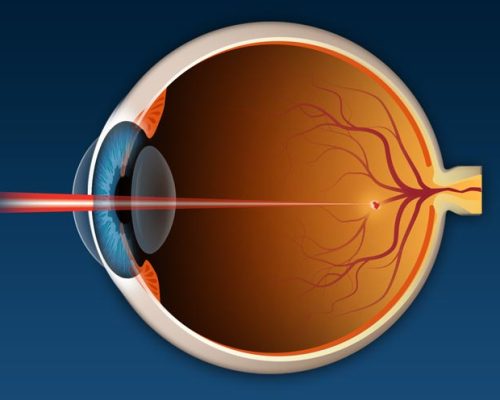 photocoagulation-330x248@2x