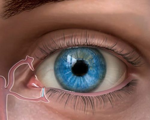 punctal-plug-678x446-compressor